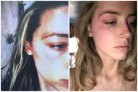 Amber Heard comparte fotos de abuso